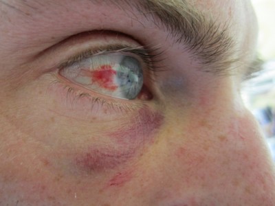 Das kann schon mal ins Auge gehen